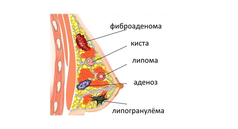 Липома в позвоночнике что это такое Липома в позвоночнике что это такое