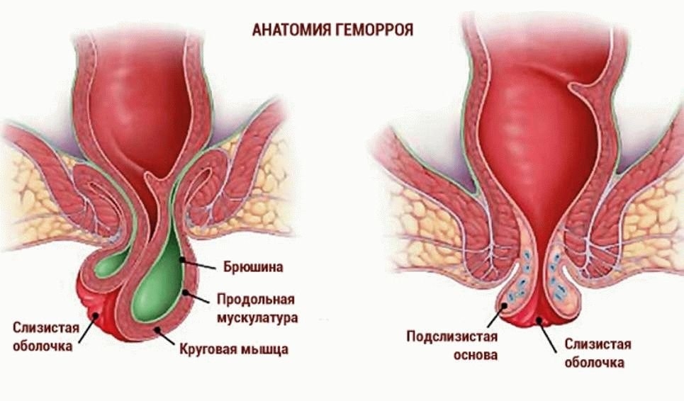 Как выглядит геморрой у женщин и как его лечить Как выглядит геморрой у женщин и как его лечить