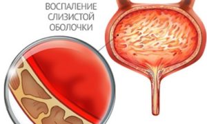 Как лечить цистит при грудном вскармливании Как лечить цистит при грудном вскармливании