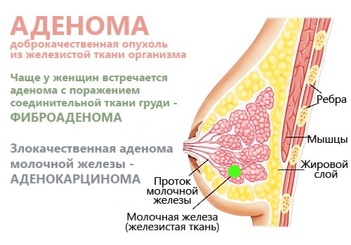 Киста гипофиза это и есть аденома Киста гипофиза это и есть аденома