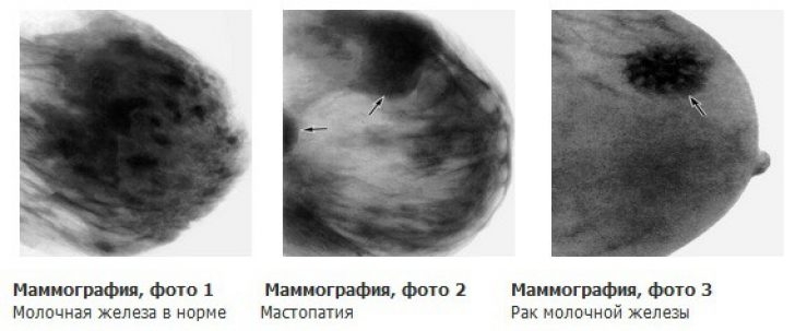 Маммография в какой день цикла делать 51