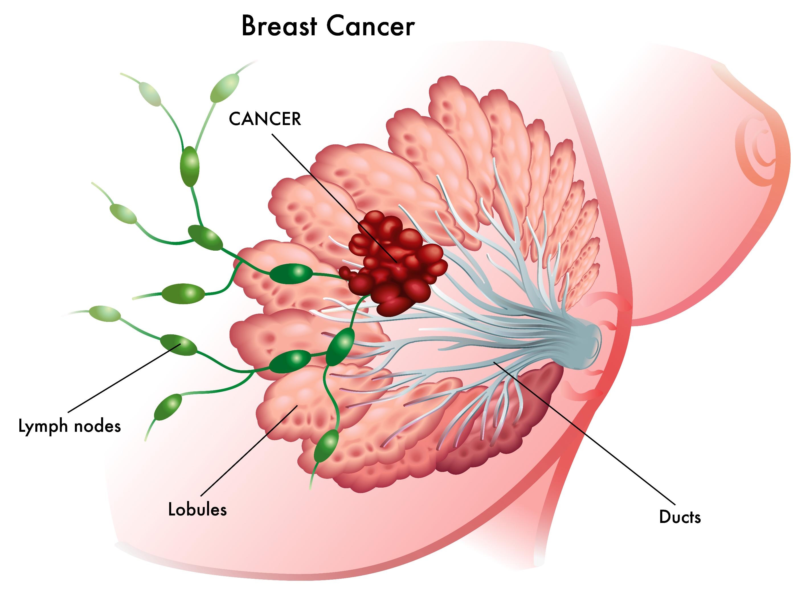 виды рака молочной железы