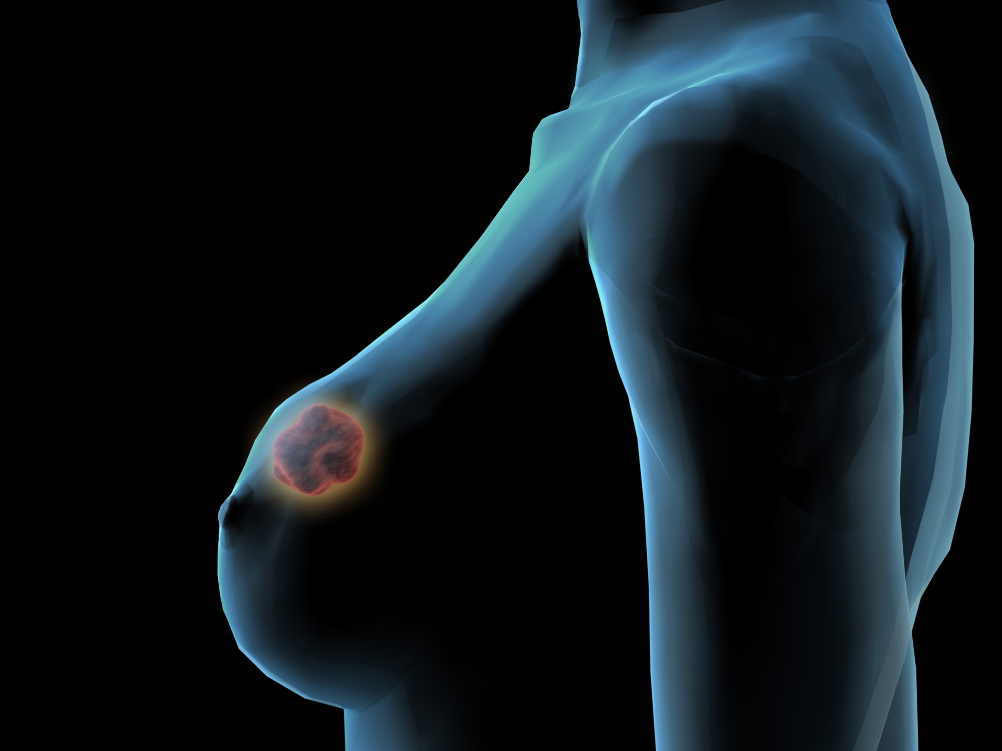 признаки рака груди у женщин первые признаки фото 107