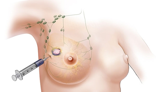 что показывает биопсия молочной железы