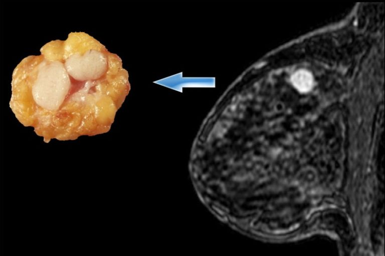 Фиброаденома молочной железы картинки