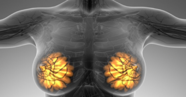 фиброзно-кистозная мастопатия