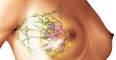 диффузная мастопатия