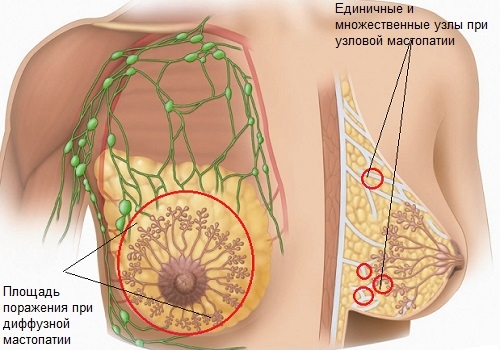 диффузная мастопатия