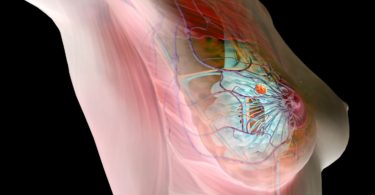 фиброма молочной железы