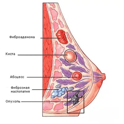 фиброз молочной железы