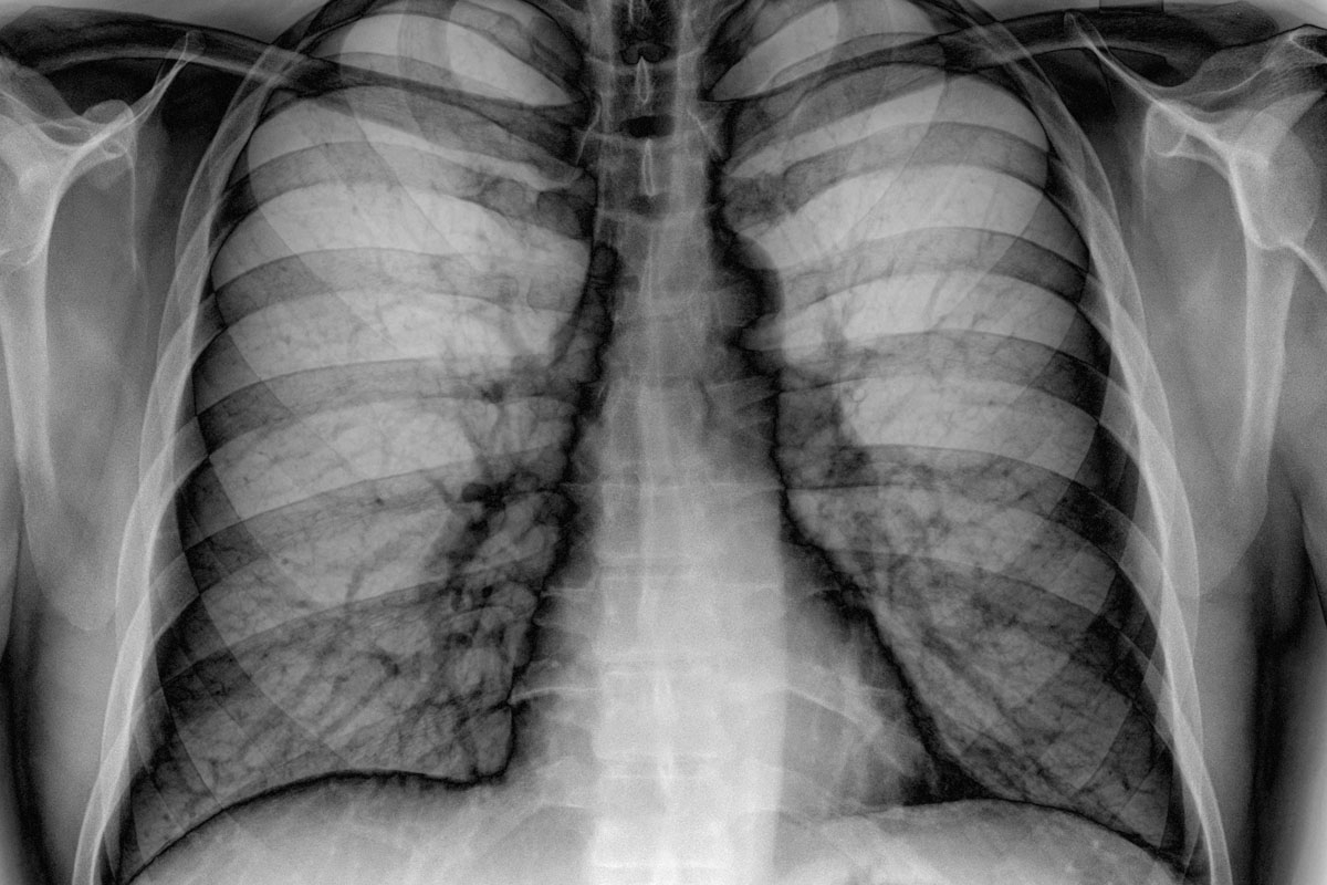 флюорография при грудном вскармливании