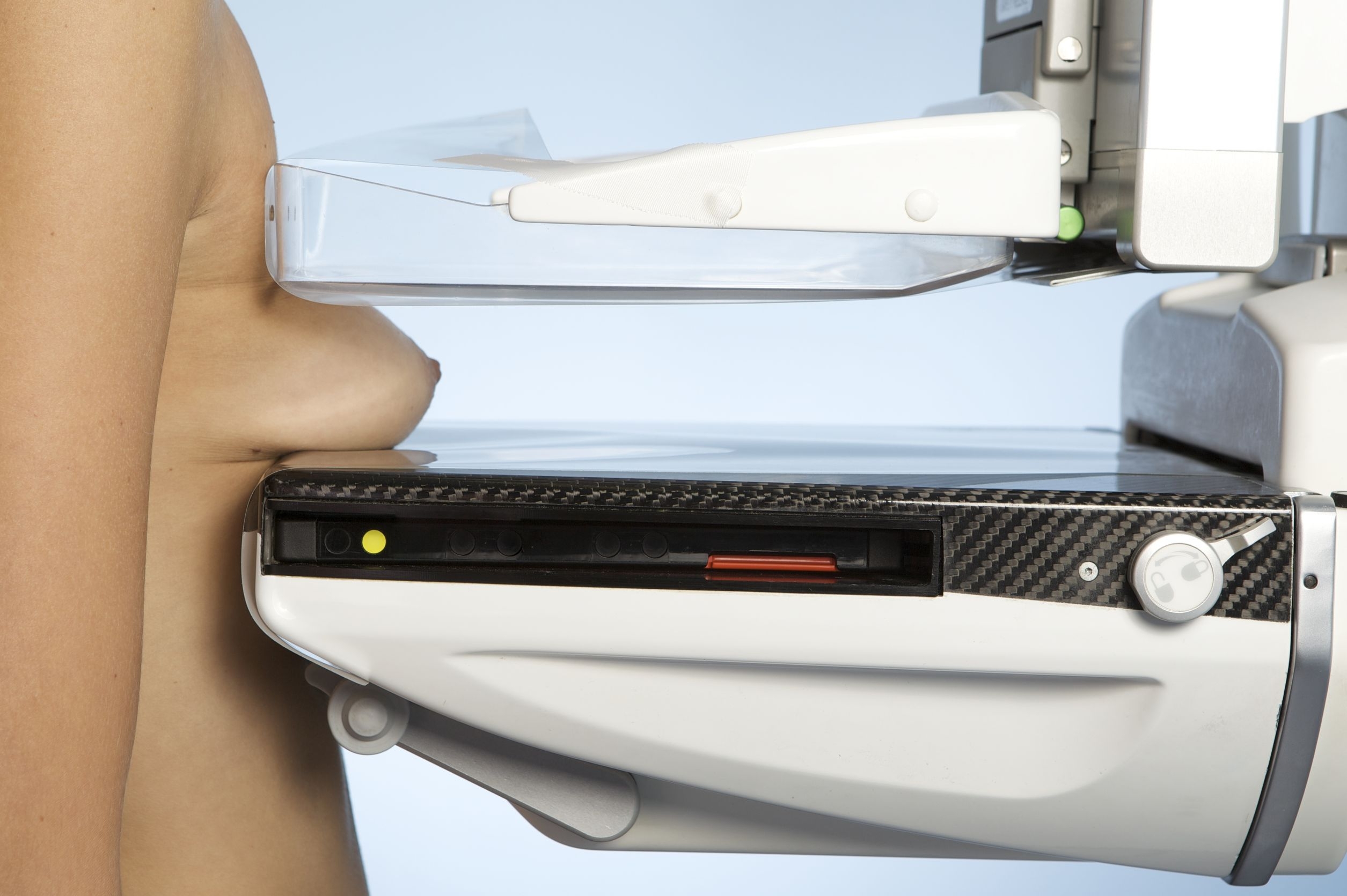 кальцинаты в молочной железе