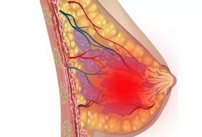 аденома молочной железы