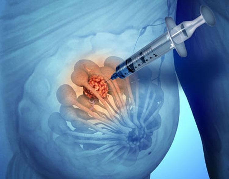 аденома молочной железы