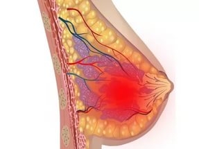 аденома молочной железы