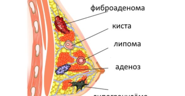 доброкачественная опухоль груди
