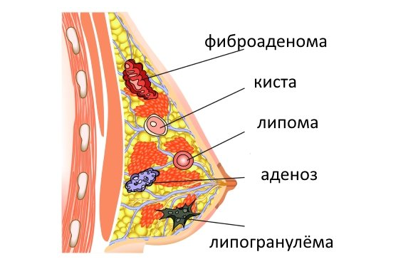 доброкачественная опухоль