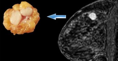 фиброаденома молочной железы удалять или нет