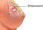 фиброаденоматоз молочной железы что это такое