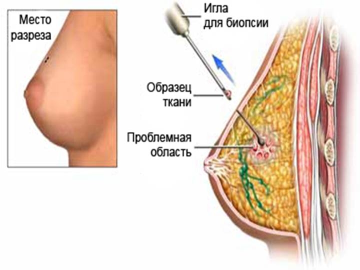 фиброаденоматоз