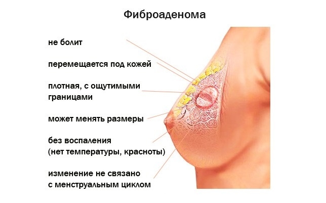 фиброаденоматоз