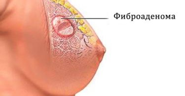 фиброаденоматоз молочной железы что это такое