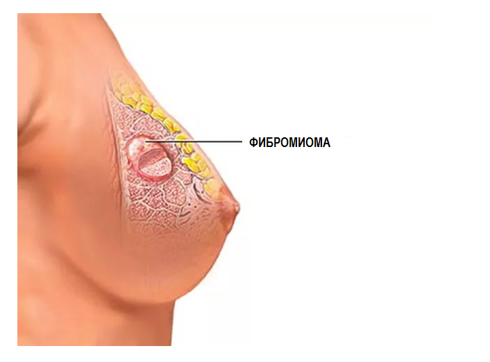 Болит ли грудь при фибромиоме thumbnail