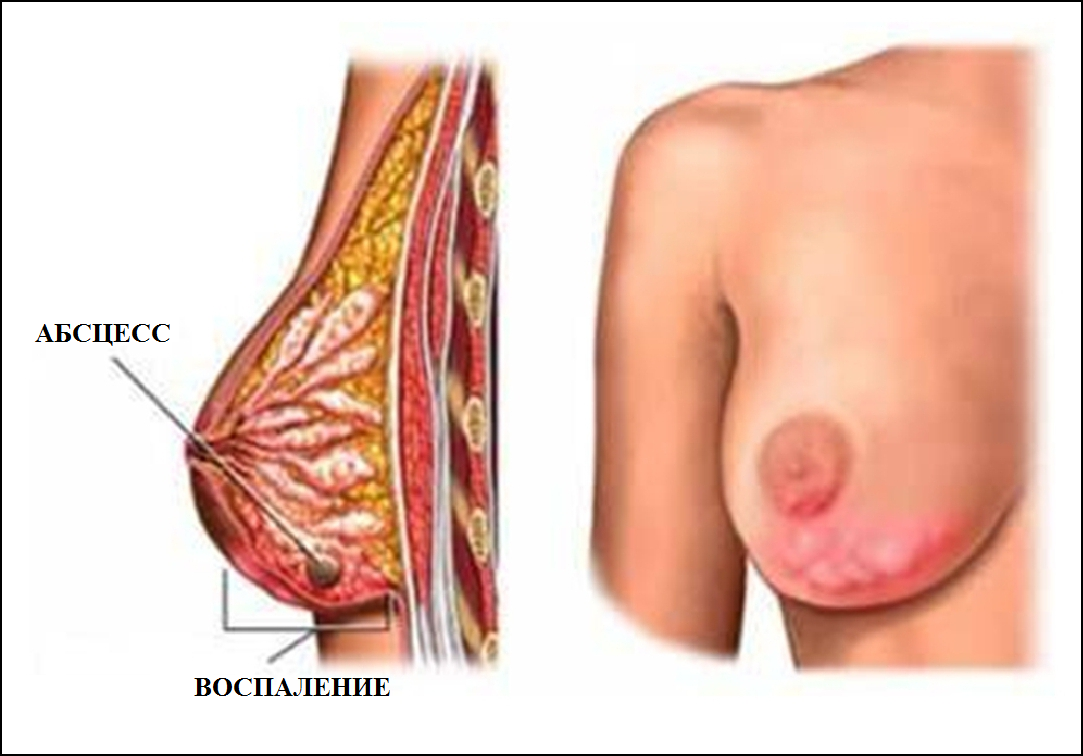 Гнойный мастит: причины возникновения, симптомы, виды, методы лечения