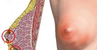 гнойный мастит