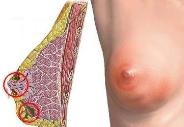 гнойный мастит