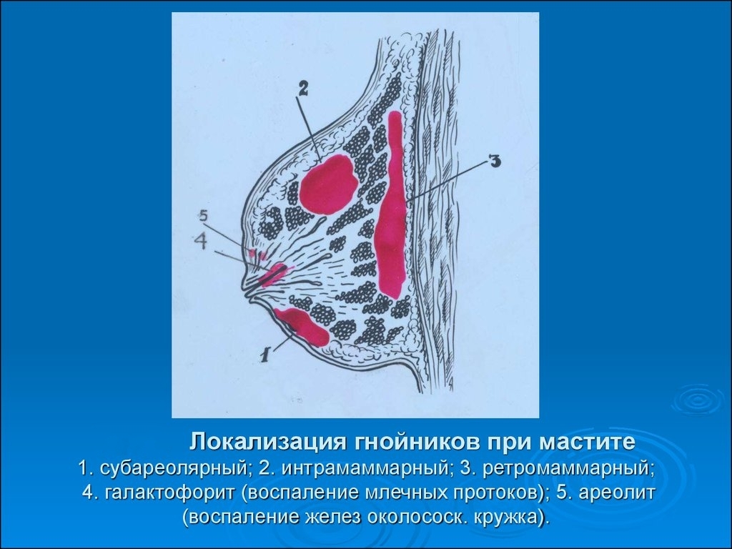 Мастита груди. Ретромаммарный Гнойный мастит. Гнойный мастит галактофорит. Локализация гнойников при мастите.