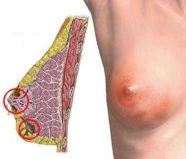 гнойный мастит