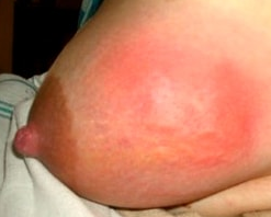 гнойный мастит