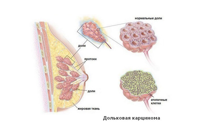 инвазивный рак молочной железы