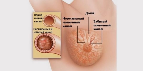 Расцеживание молочной железы