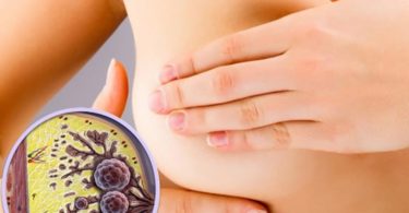 карцинома молочной железы