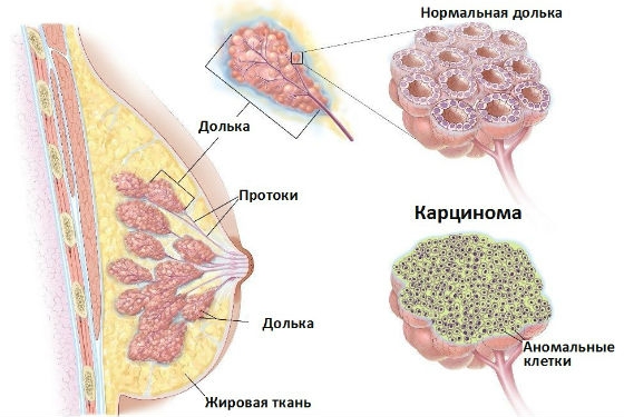 карцинома молочной железы