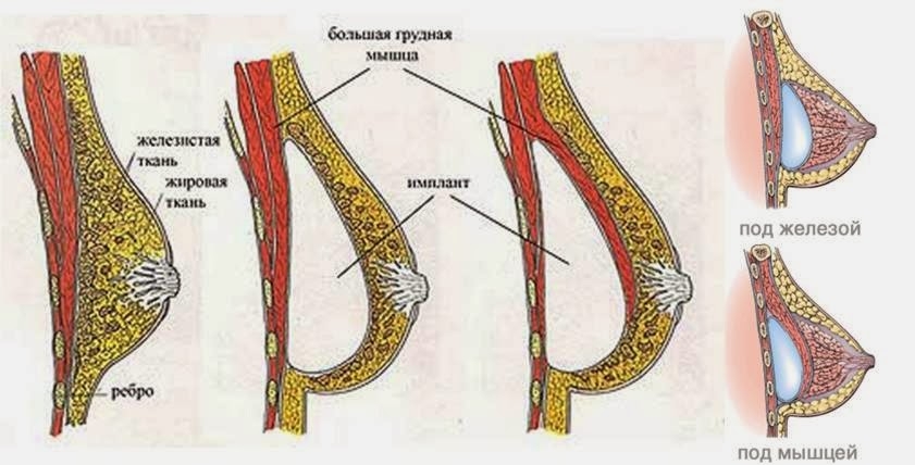 Имплант под грудную мышцу