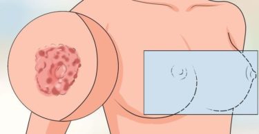 красные пятна на груди