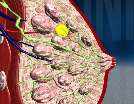 лечение мастопатии у женщин