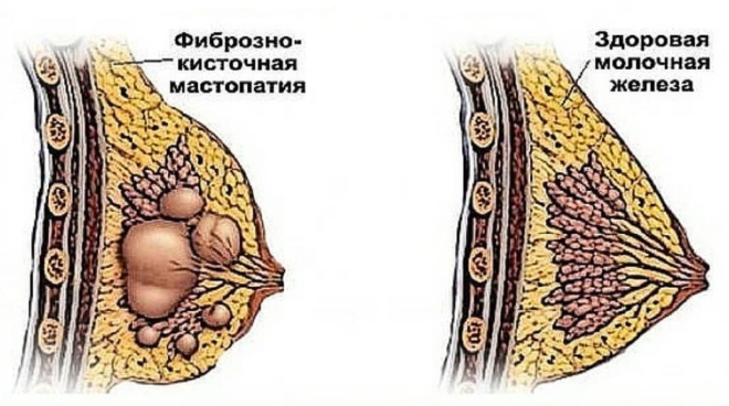 лечение мастопатии у женщин
