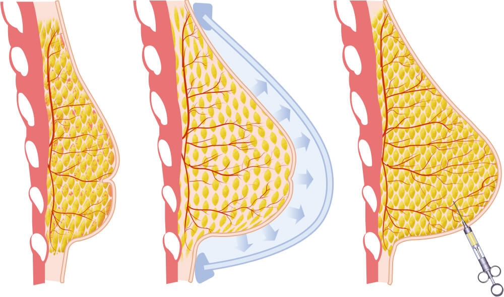 липофилинг