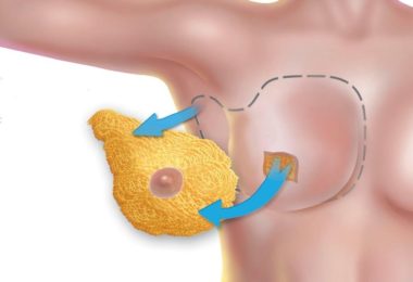 мастэктомия это