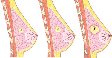 мастопатия причины