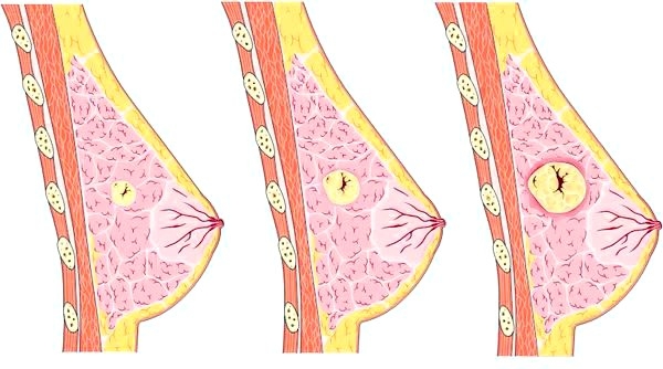 мастопатия причины