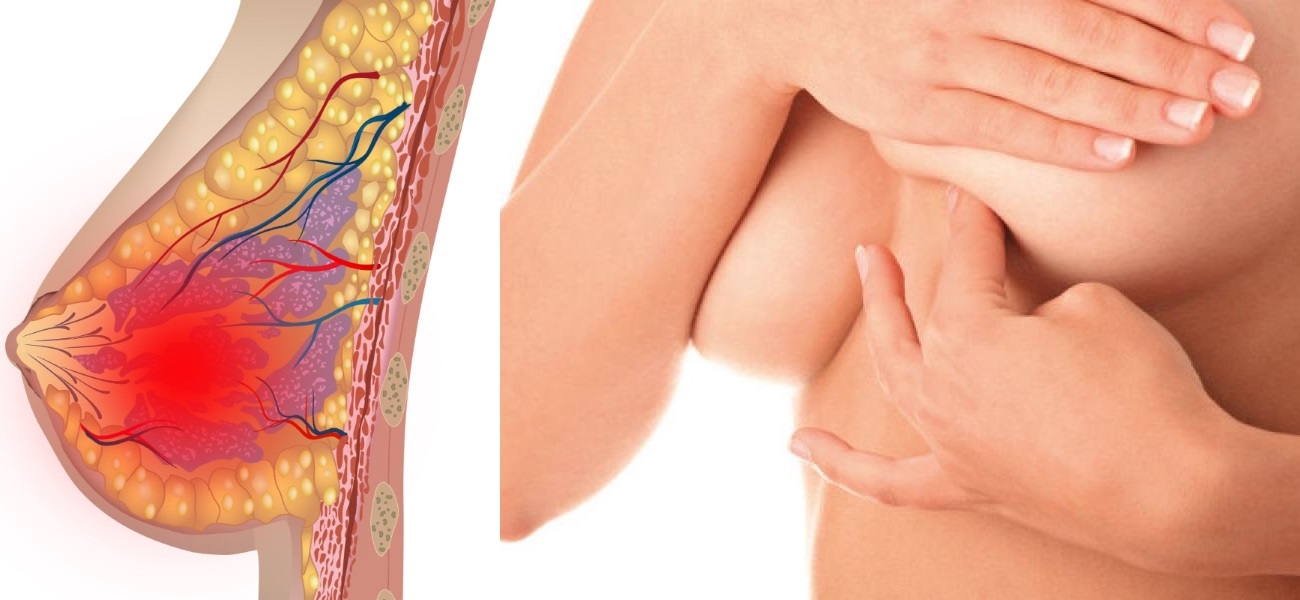 мастопатия