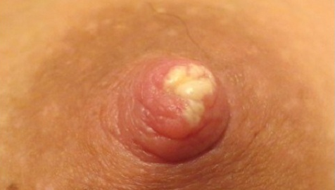 молочница при ГВ