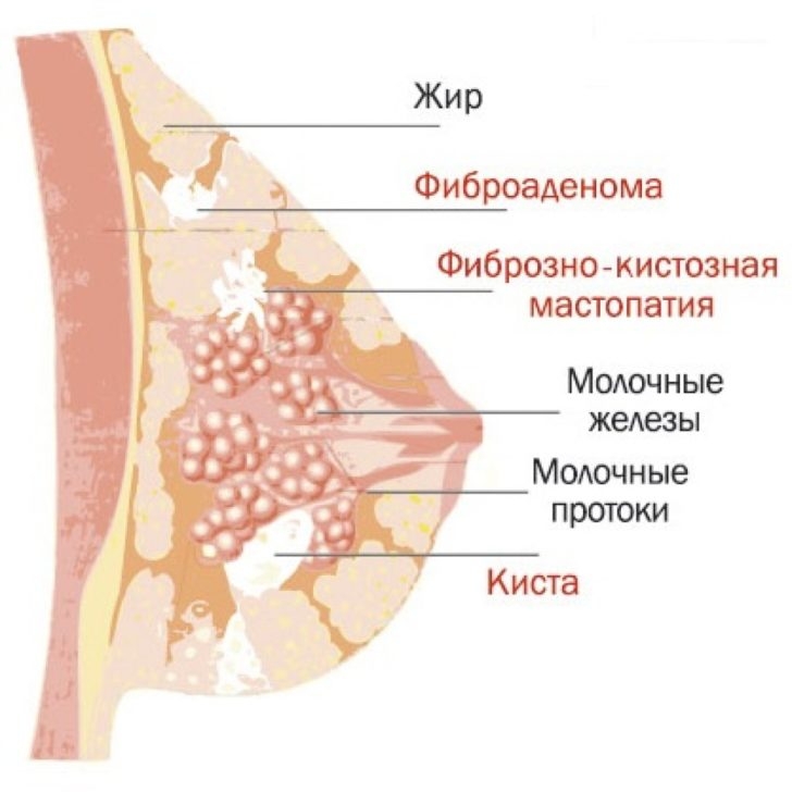 диффузная мастопатия