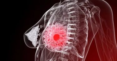 очаговое образование молочной железы что это такое