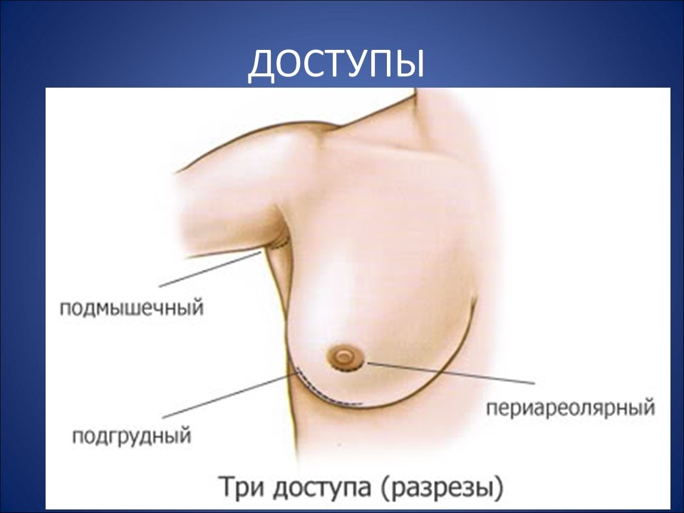 подтяжка грудных желез